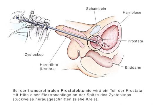 Prostata Turp Kullanımı ve Faydaları Nelerdir?